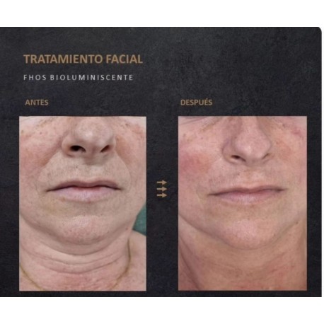 SERVICIOS: Sesión Fhos Recuperadora